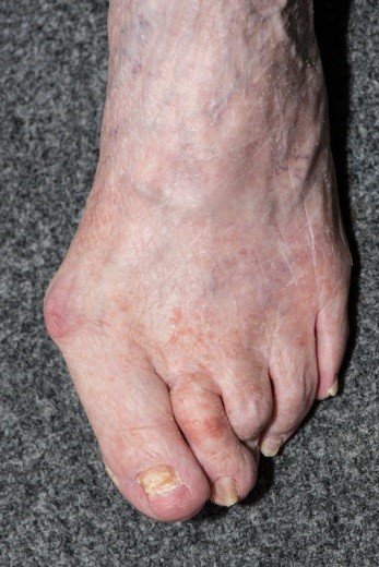 hammertoe3