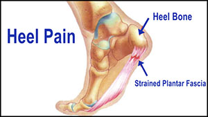 heel pain