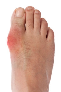 Intense Pain May Be Associated with Gout