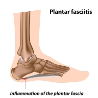 Can Other Foot Problems Cause Plantar Fasciitis?