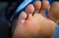 Why Corns May Develop on the Feet