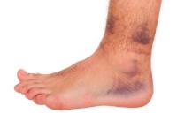 How Does an Ankle Sprain Occur?