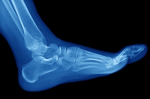 Types of Arthritis