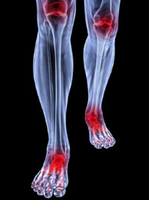 Preventing Foot Wounds if You Have Arthritis
