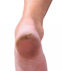 Moisturizing May Help Cracked Heels