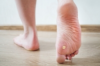 The Growth of Plantar Warts on the Feet