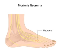 What Can Cause Morton's Neuroma?