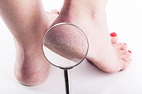 Are Cracked Heels a Common Foot Condition?