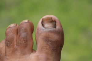 Managing and Preventing Toenail Fungus