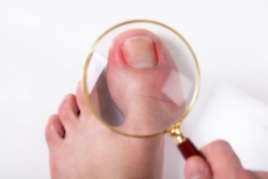 Ingrown Toenail Facts