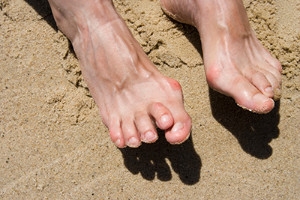 Managing Hammertoe